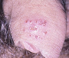 Herpes Genital | Patologias Dermatologicas